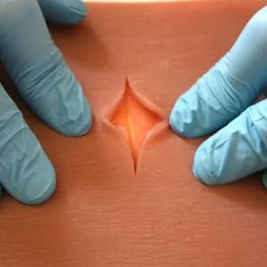 PREMIUM 3-Layer Suture Patch