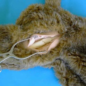 Femoral Leg Bone Fracture