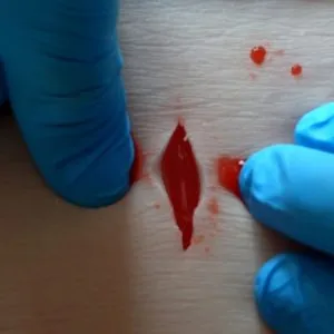 Haemostasis Pad Mini (HP Mini)